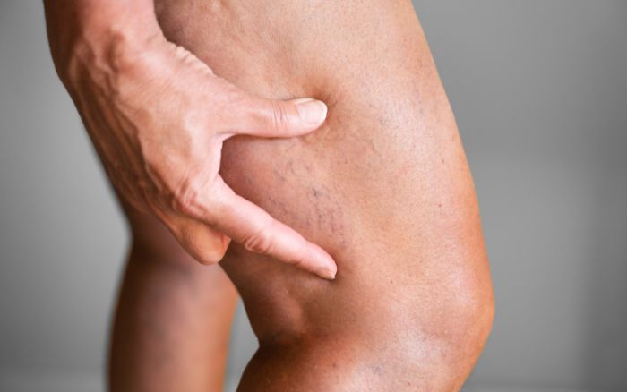 Gambe pesanti sintomi, rimedi e miglior integratore