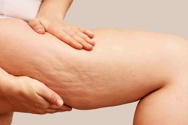Guida completa per combattere la ritenzione idrica: integratori, dieta e esercizi